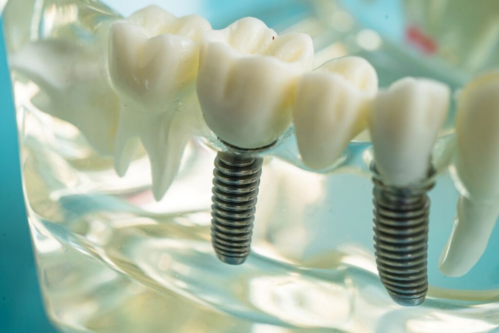 Understanding biological dental implants